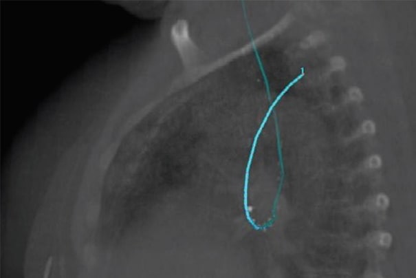 LumenCare® applicator – Image courtesy of the UZL Gasthuisberg, Leuven, Belgium