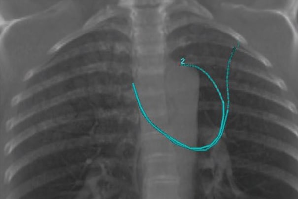 LumenCare® applicator – Image courtesy of the UZL Gasthuisberg, Leuven, Belgium CT